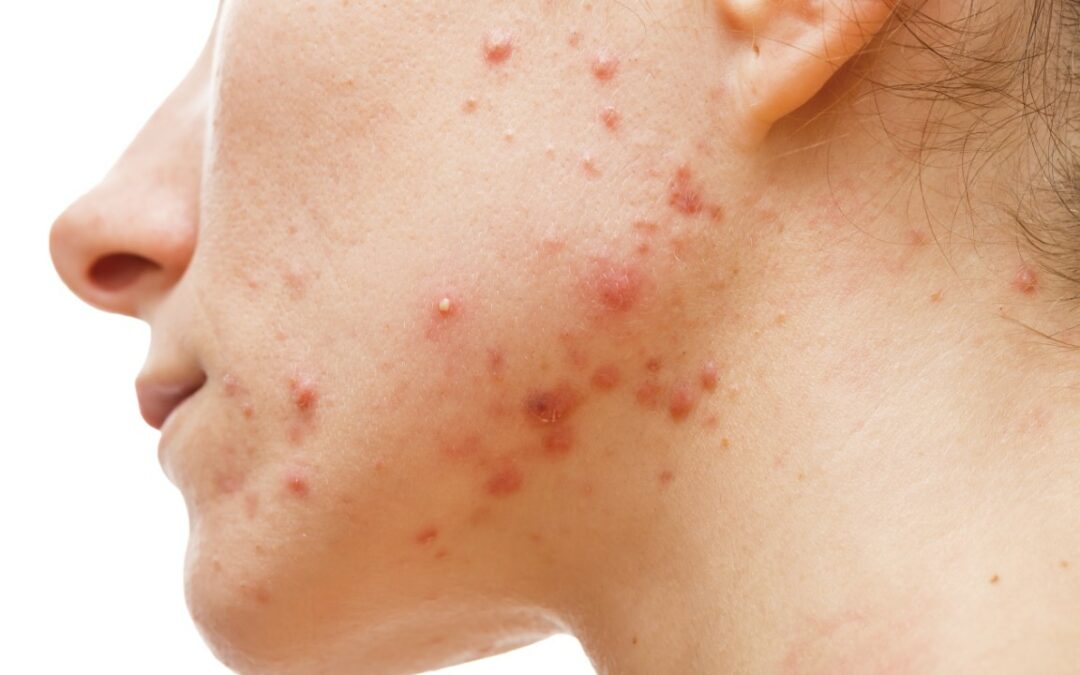 Man Secretly Feeds Vegan Girlfriend Dairy to Check If It Will Cause Acne